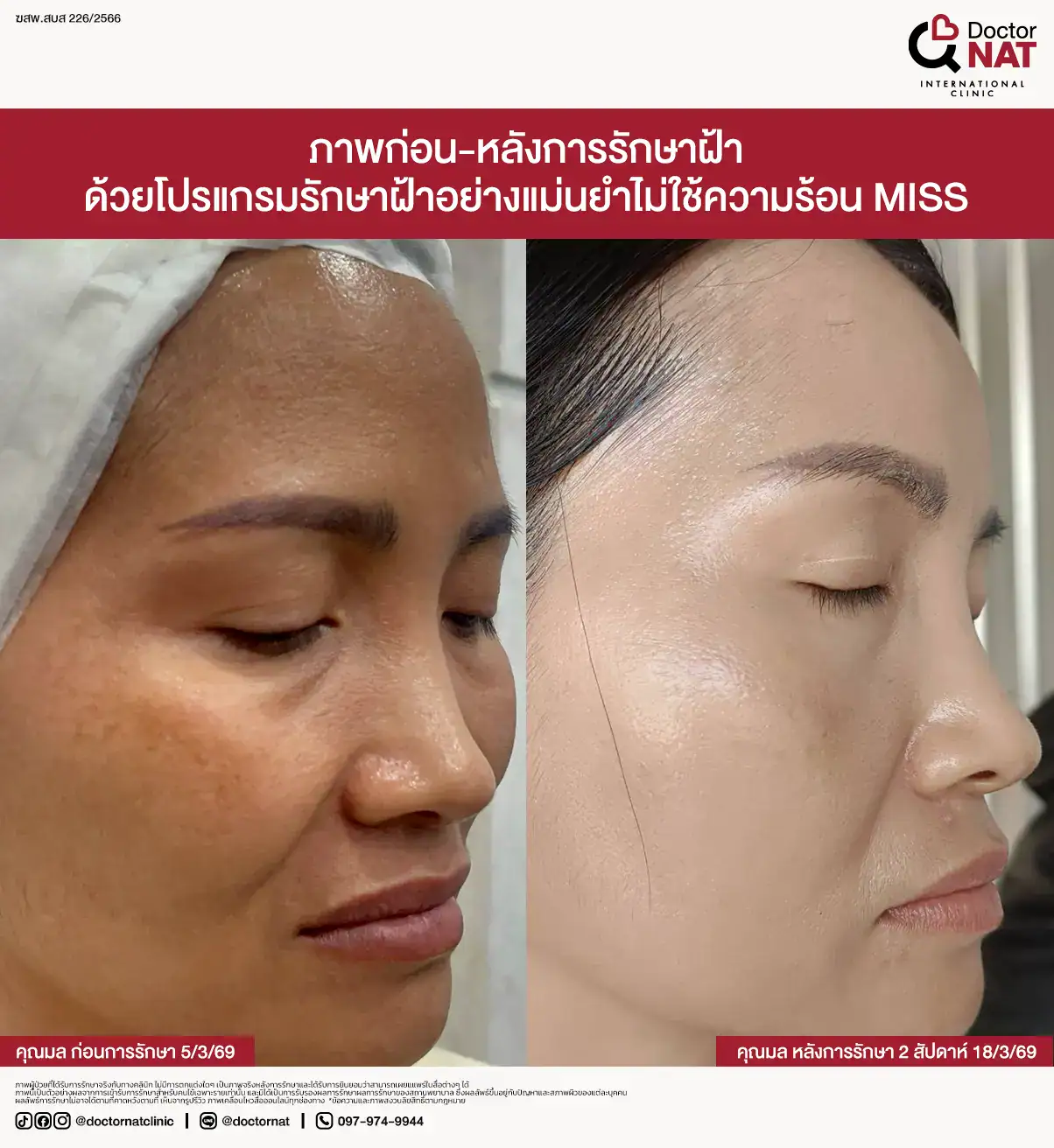 Doctor NAT Clinic วิเคราะห์ฝ้าก่อนเลือกวิธีรักษา