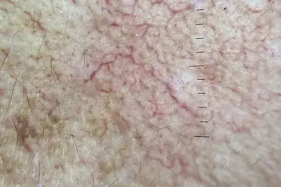 Advanced Melasma Dermoscopy วิเคราะห์เม็ดสีและเส้นเลือดใต้ผิว