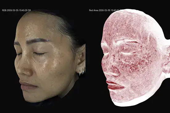 Melasma Mapping 3D ตรวจฝ้า 3 มิติก่อนรักษา