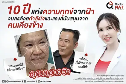 รีวิวรักษาฝ้าเรื้อรังเคสจริง