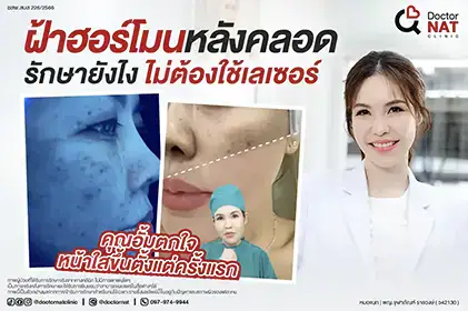 รีวิวรักษาฝ้าฮอร์โมนหลังคลอดเคสจริง
