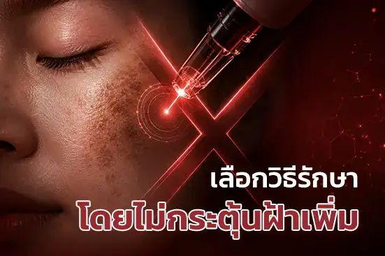 เลือกวิธีรักษาฝ้าโดยไม่กระตุ้นฝ้าเพิ่ม